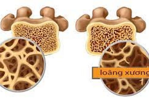 Dấu hiệu nhận biết loãng xương ở người cao tuổi