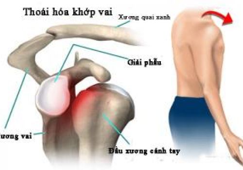 3 Bệnh Khớp Vai Thường Gặp Ở Người Cao Tuổi