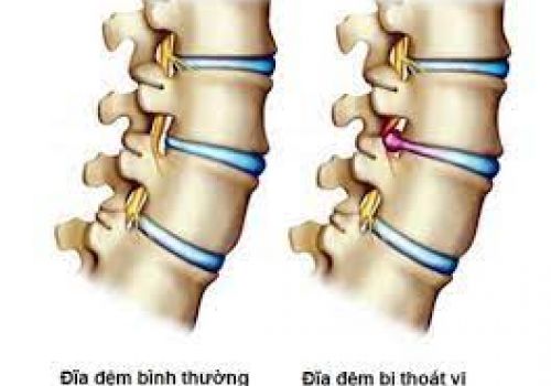 Người có những thói quen này dễ bị thoát vị đĩa đệm trầm trọng