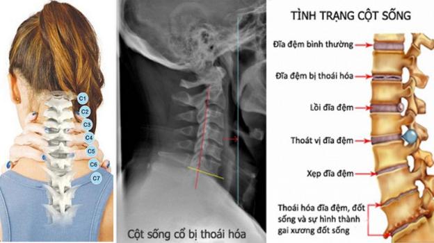 thoái hoá cột sống cổ