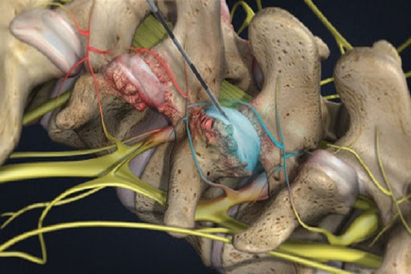 Chua-dau-lung-thoat-vi-dia-dem-bang-cach-nao-1